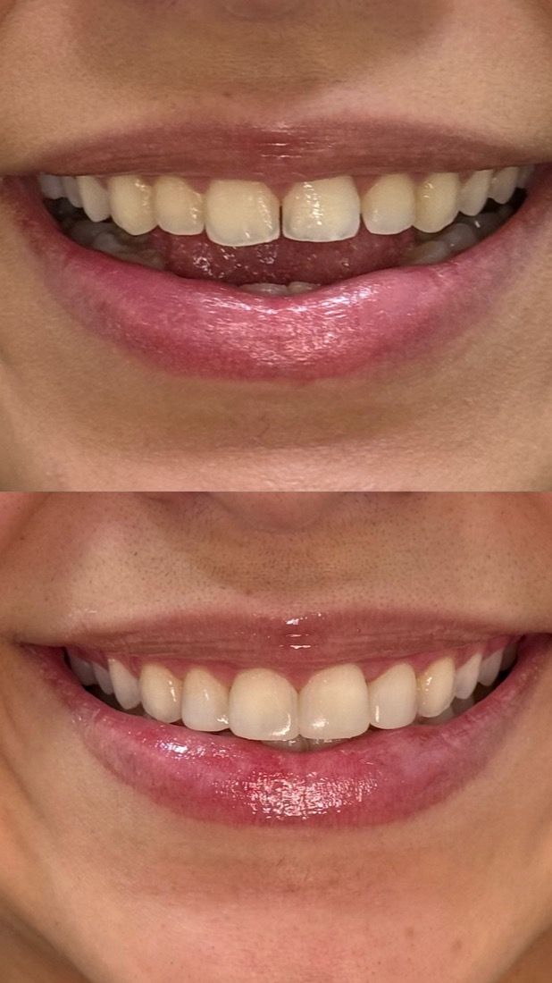 Antes e depois de facetas em resina, paciente da Brivva